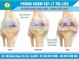 Điều trị thoái hóa khớp gối